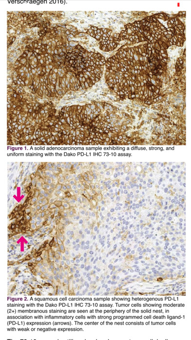 IASLC Atlas of PD-L1 Testing in Lung Cancer screenshot 4