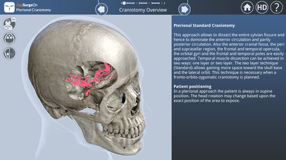 Pterional Craniotomy screenshot 2