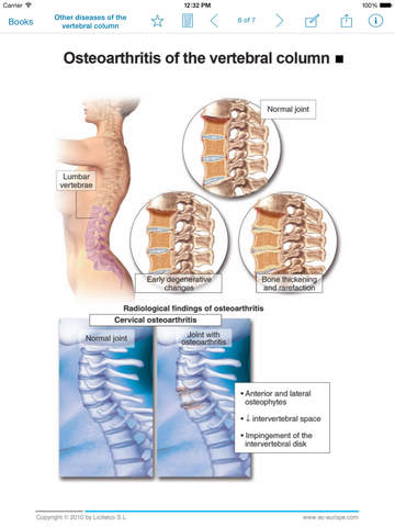 【免費醫療App】Miniatlas Diseases of the vertebral column-APP點子